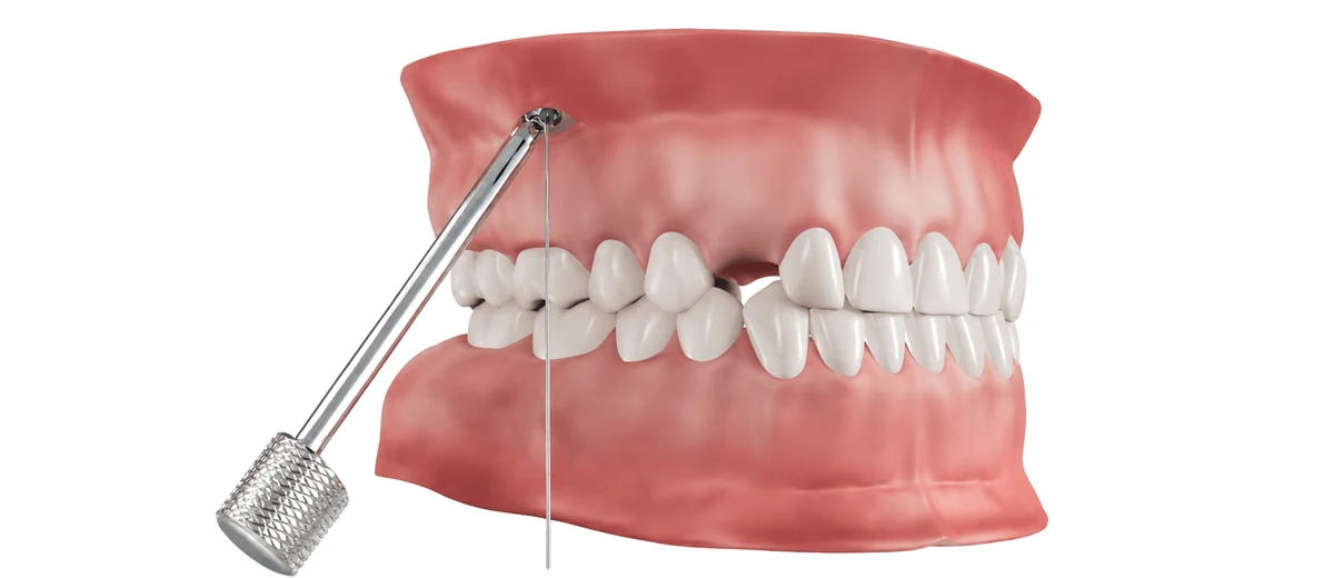 Système CT8 — ancrage osseux orthodontique