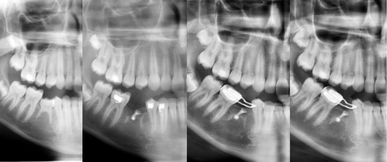 Figure 6  : cas 2, suivi radiographique de la croissance osseuse sur 3 ans