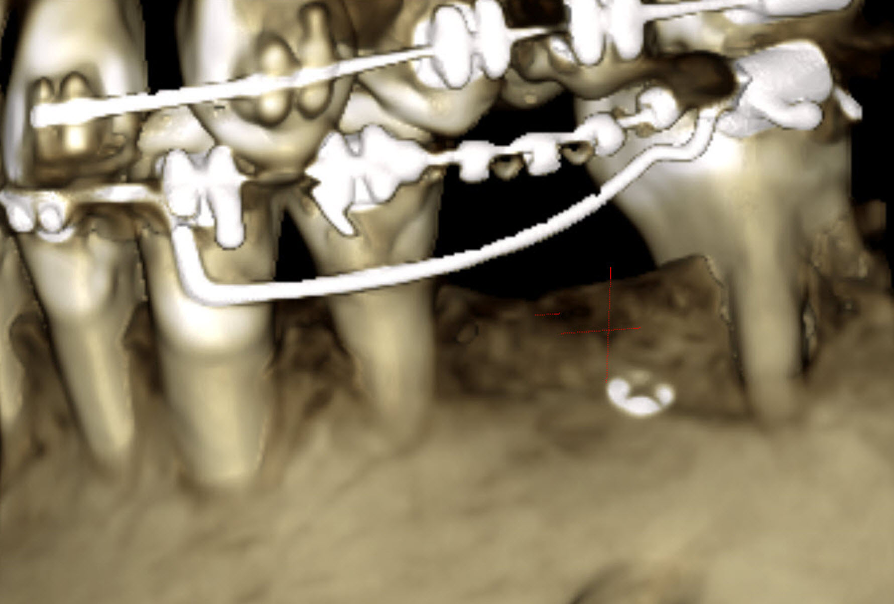 Figure 5 : cas 1, rendu surfacique au CBCT à 3 ans