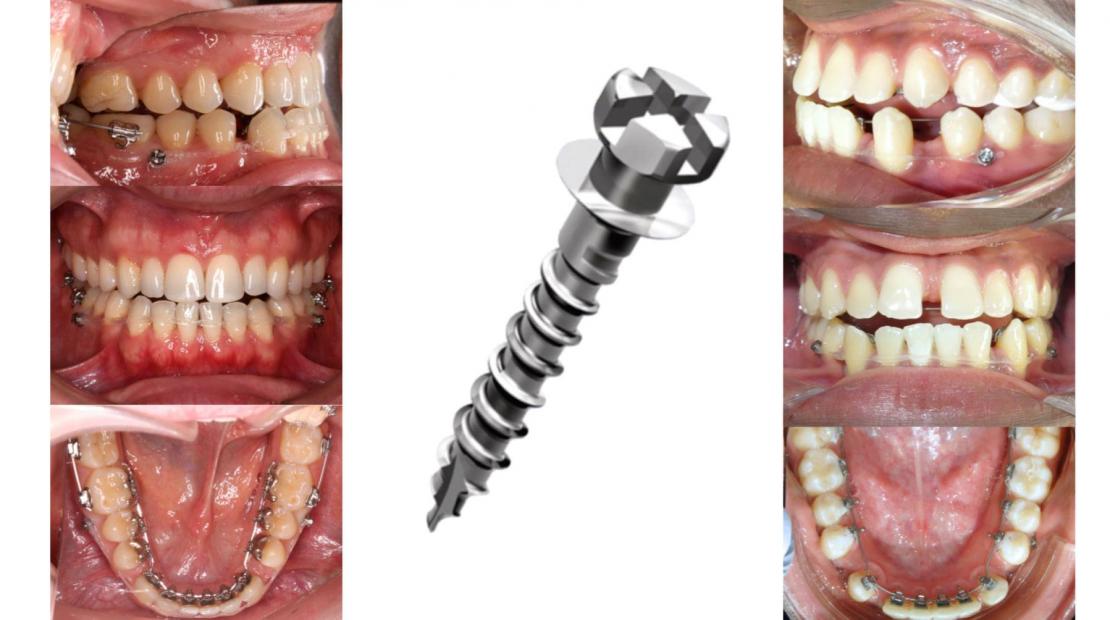 Les mini-vis en orthodontie