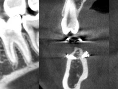 Figure 7 : cas 2, coupes CBCT à 3 ans