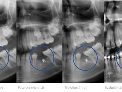 Figure 3 : cas 1, suivi radiographique de la croissance osseuse sur 3 ans