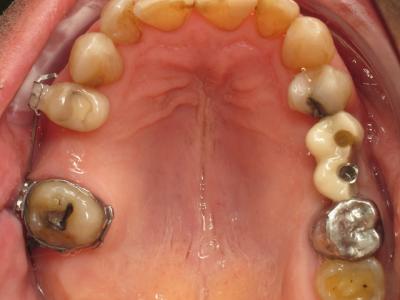 Cas 2 - Vue occlusale intermédiaire