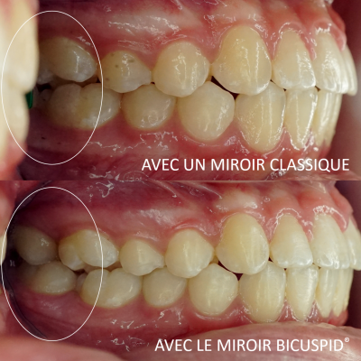 BILXXY 5pcs Miroirs de Photographie Dentaire, réflecteur en Verre occlusal  de la Bouche Miroir buccal Intra-Oral Dentaire Outil Dentaire Photographie