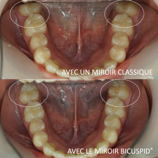 Miroir photo lingual orthodontique en verre 1und