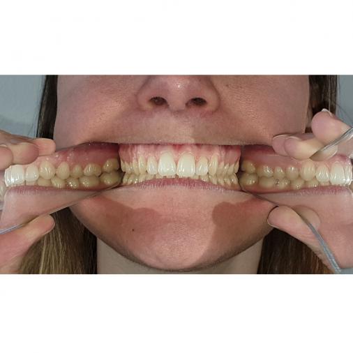 Miroir photographie dentaire Triomphe- Miroir photographique intra-oral  orthodontique dentaire, miroir réflecteur à 2 côtés, stomatoscope