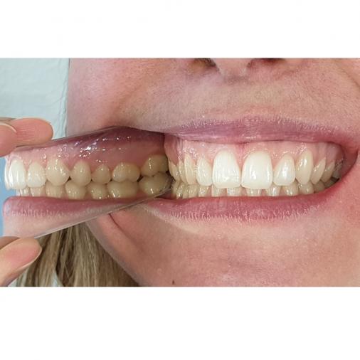 Miroir photographie dentaire - Miroir photographique intra-oral  orthodontique dentaire, miroir réflecteur à 2 côtés, stomatoscope miroir